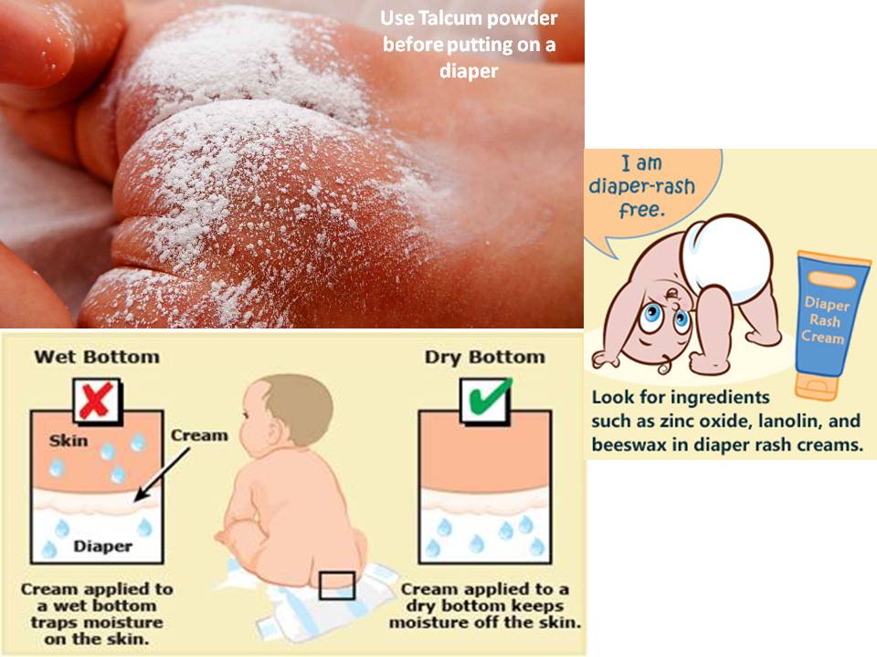 Baby Skin Yeast Infection Treatment